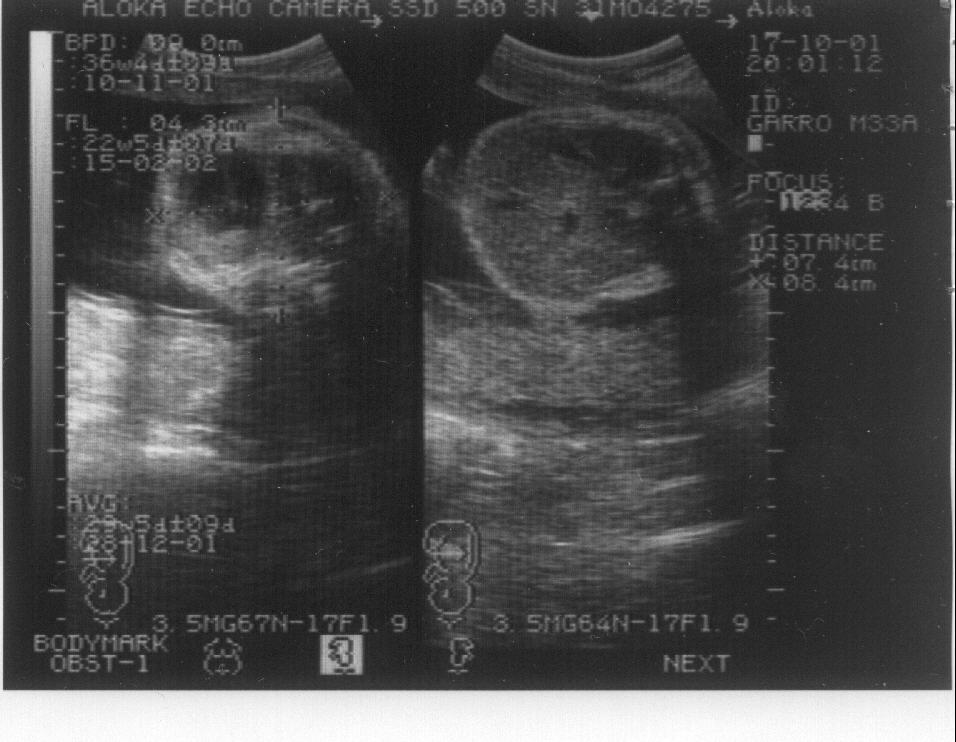 Imagen de la ecograf�a